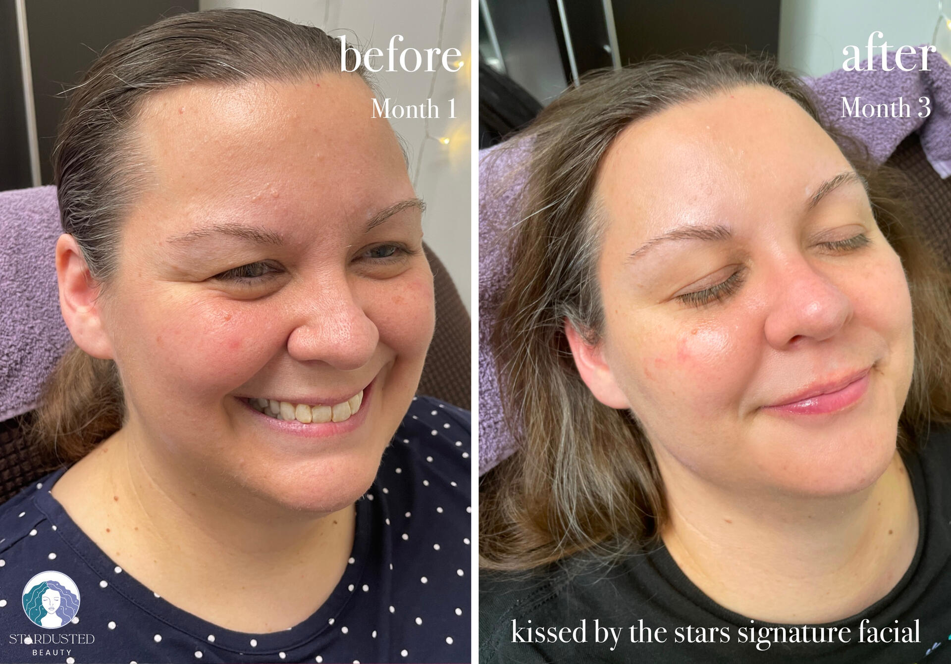 before and after facial treatment on a sensitive skin client; noticeable improvement on redness, texture, and irritation