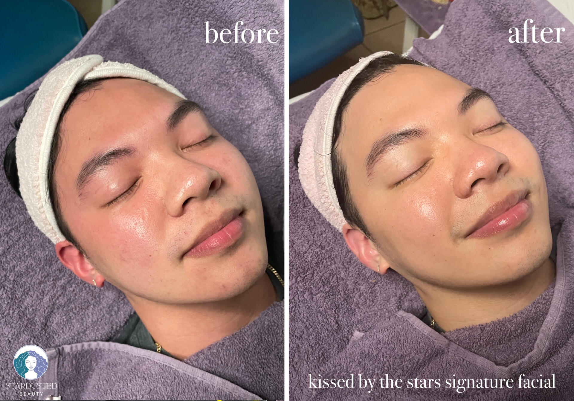 before and after asian skincare and facial treatment; improvement on pores and congestion