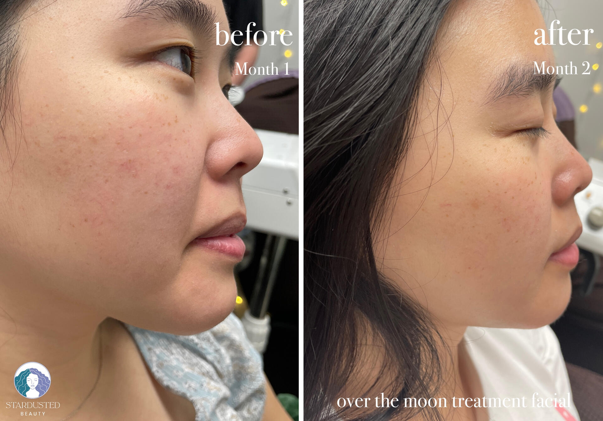 oxygen facial treatment before and after on spider veins and redness; helps with blood circulation